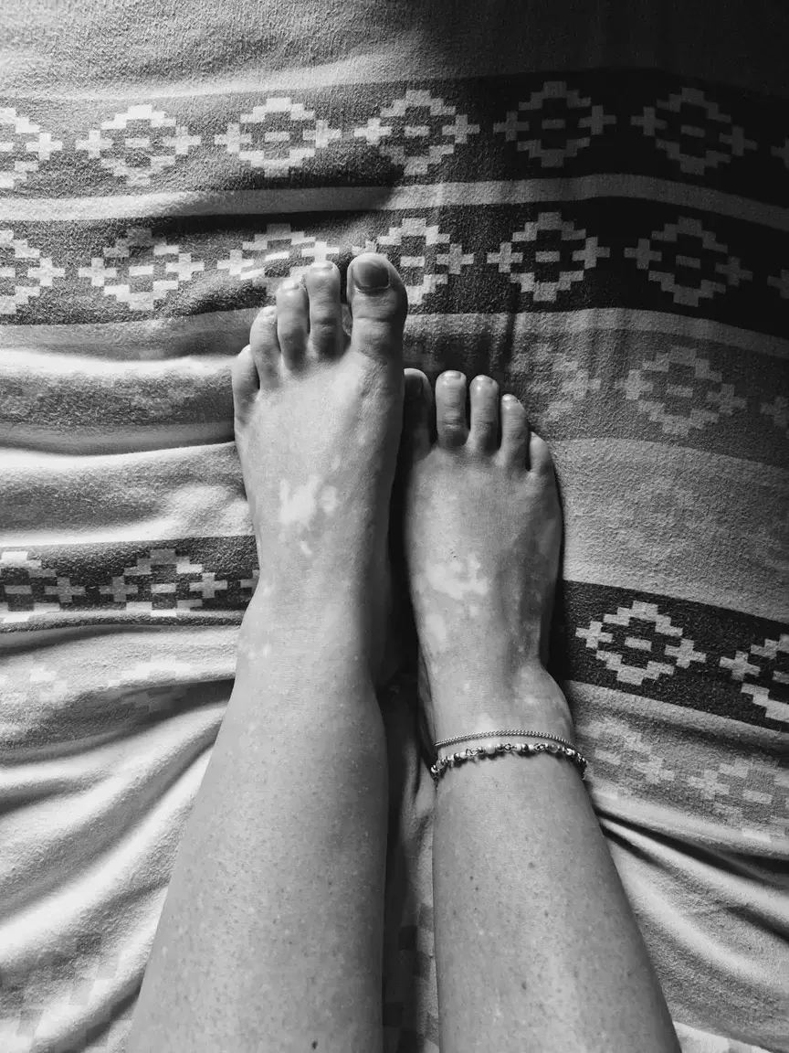 Leak & nude 1 — Vitiligirl
